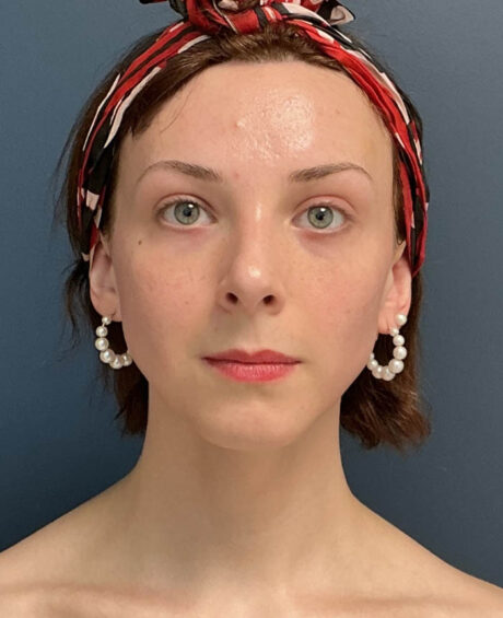 Facial Feminization Surgery case #16318