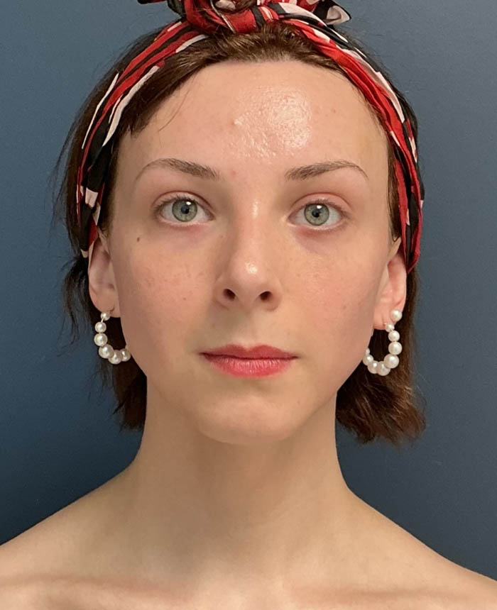 Facial Feminization Surgery case #16318