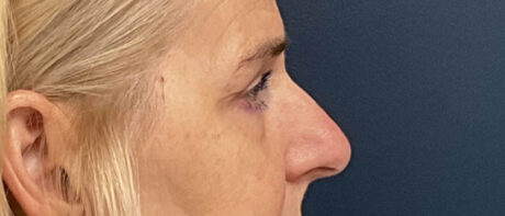 Eyelid Surgery case #16325