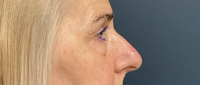 Eyelid Surgery case #16325