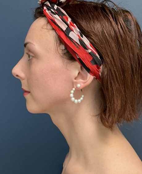 Facial Feminization Surgery case #16318