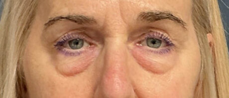 Eyelid Surgery case #16325