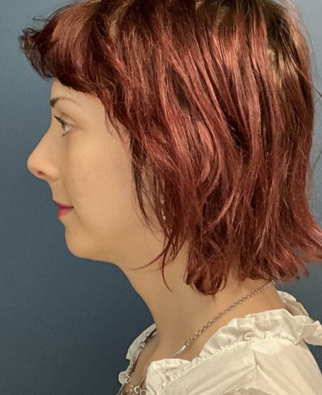 Facial Feminization Surgery case #16318