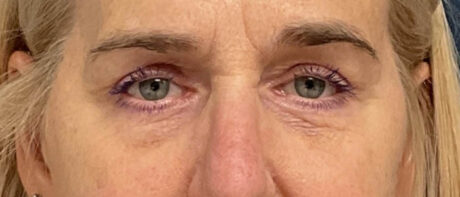 Eyelid Surgery case #16325