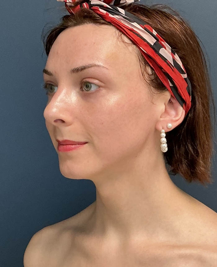 Facial Feminization Surgery case #16318