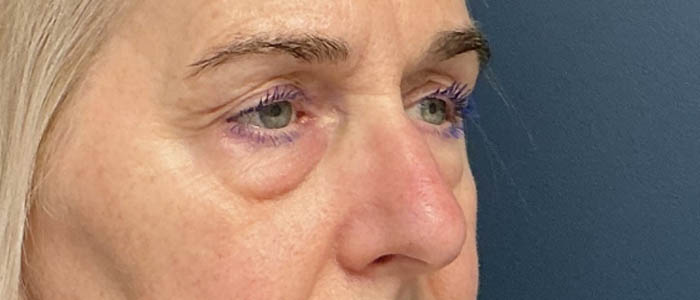 Eyelid Surgery case #16325