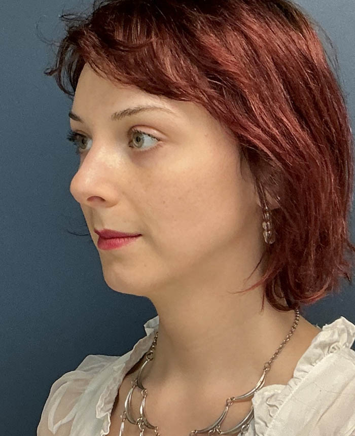 Facial Feminization Surgery case #16318