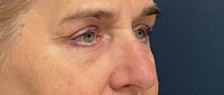 Eyelid Surgery case #16325