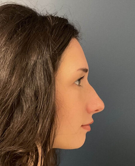 Rhinoplasty case #16311