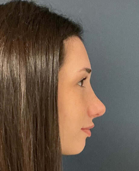 Rhinoplasty case #16311