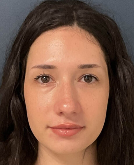 Rhinoplasty case #16311