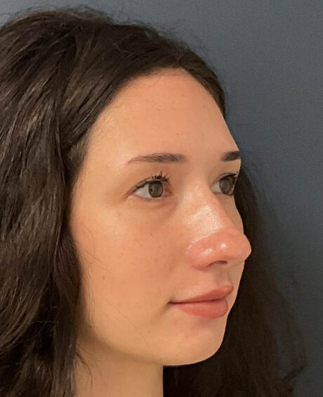 Rhinoplasty case #16311