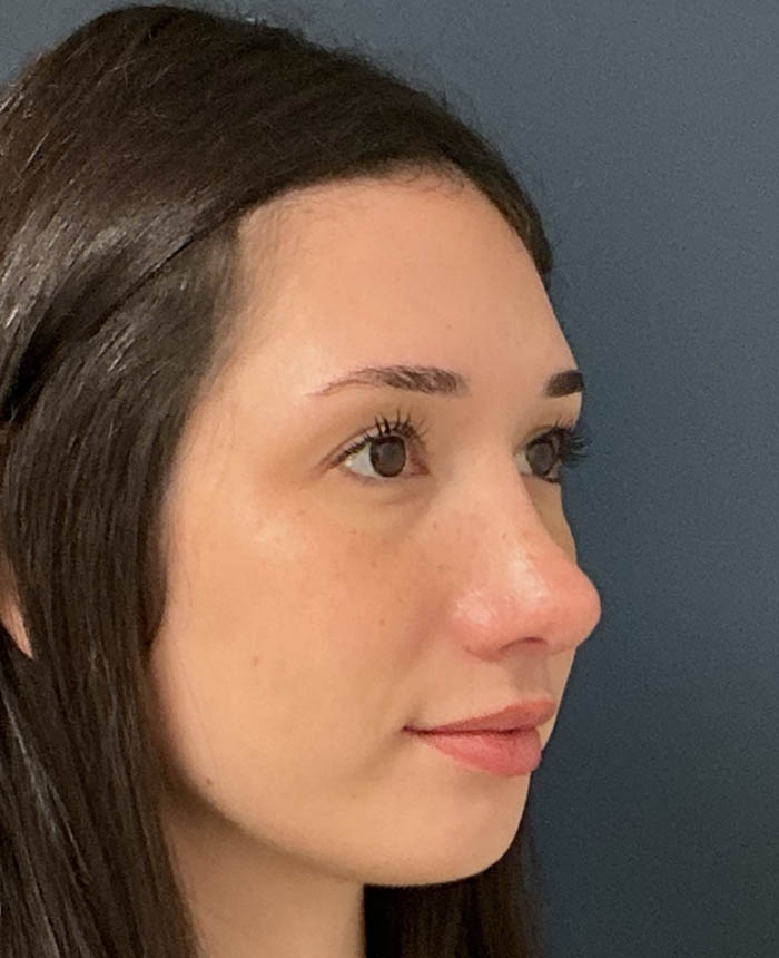 Rhinoplasty case #16311
