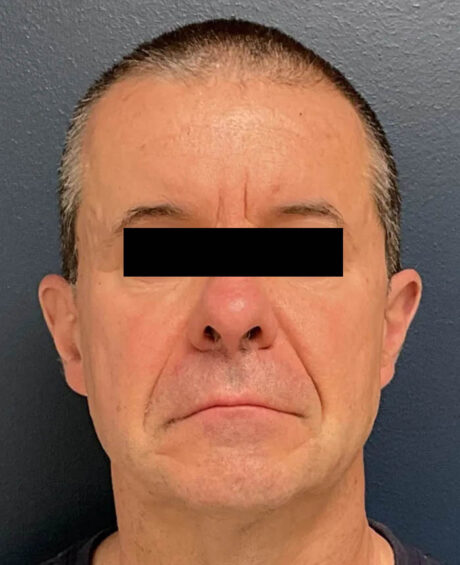 Facelift case #16332