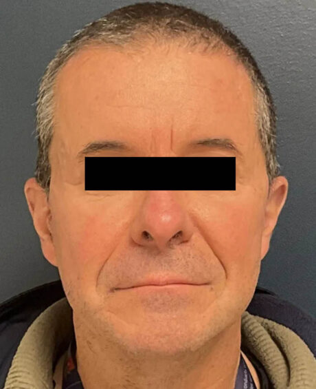 Facelift case #16332