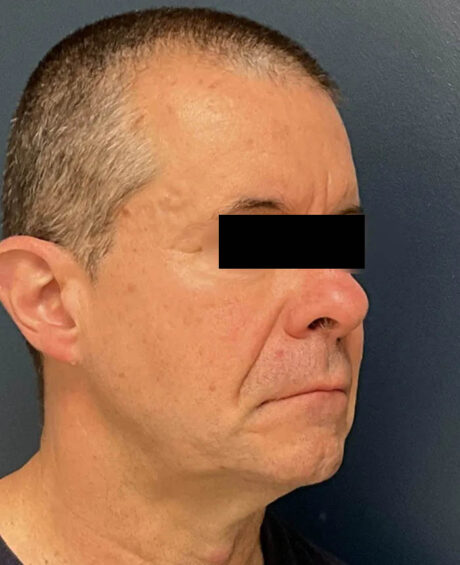 Facelift case #16332