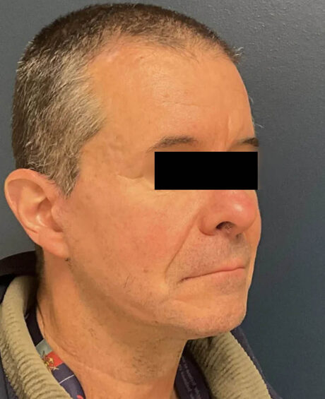 Facelift case #16332