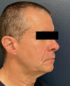 Facelift case #16332