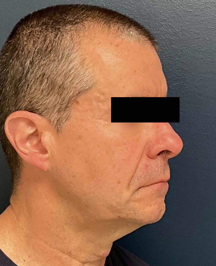 Facelift case #16332