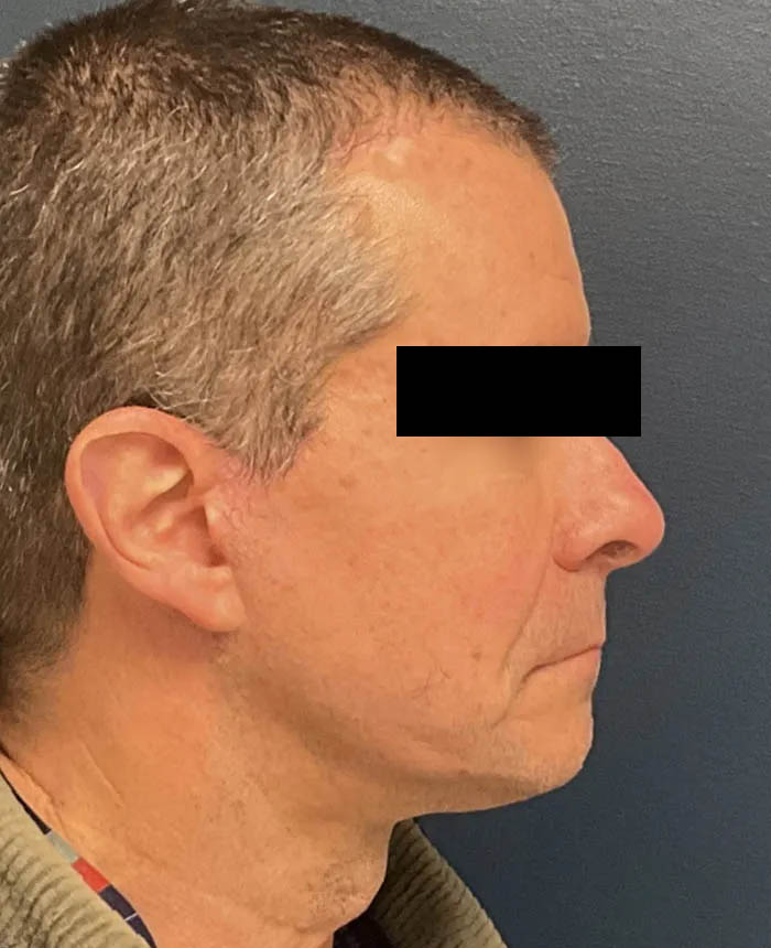 Facelift case #16332