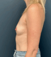 Breast Augmentation case #16058