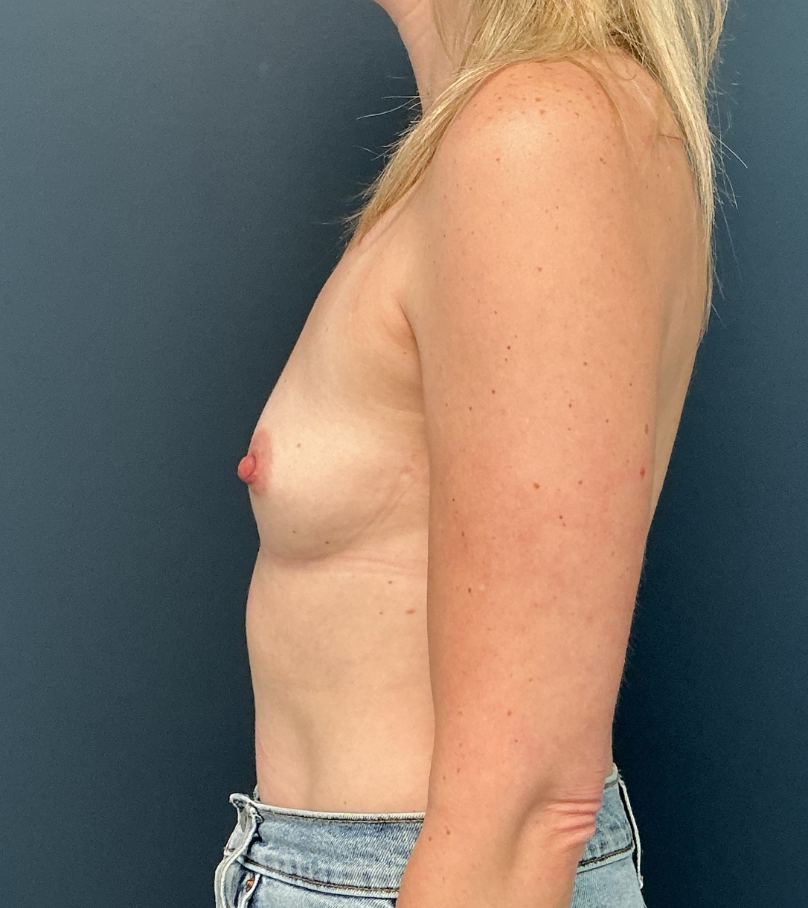 Breast Augmentation case #16058