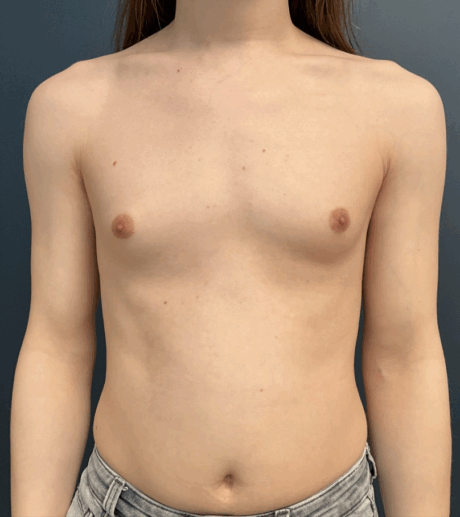 Breast Augmentation case #16065