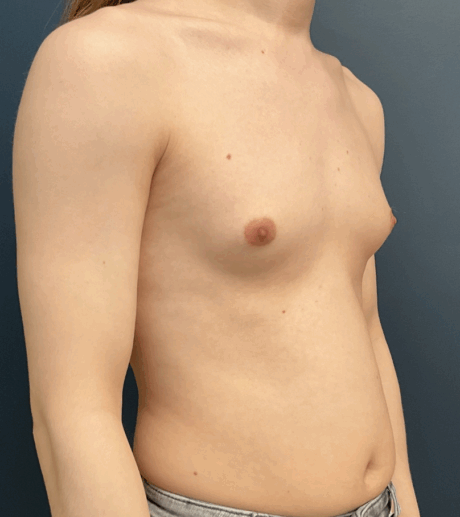 Breast Augmentation case #16065