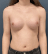Breast Augmentation case #16065