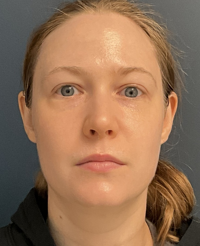 Eyelid Surgery case #16052