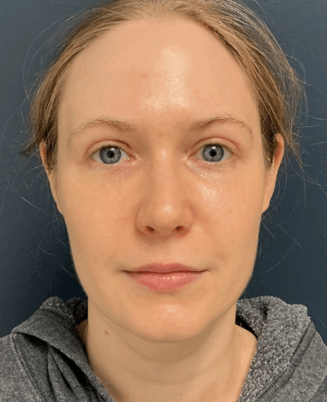 Eyelid Surgery case #16052