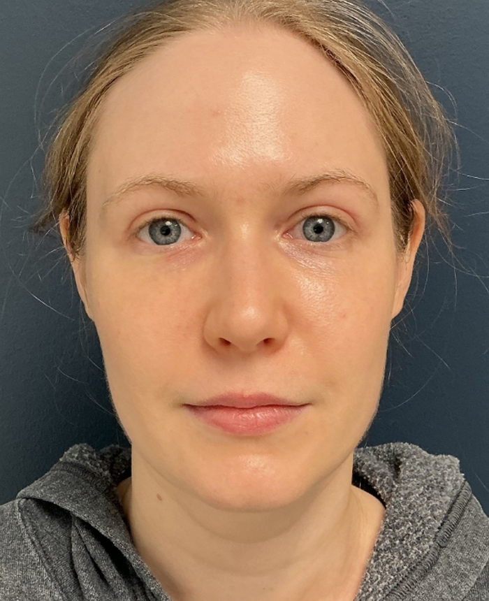 Eyelid Surgery case #16052