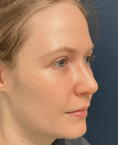 Eyelid Surgery case #16052