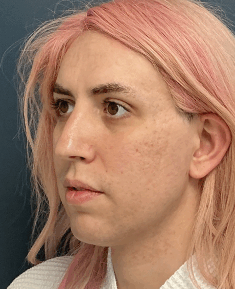 Facial Feminization Surgery case #16093