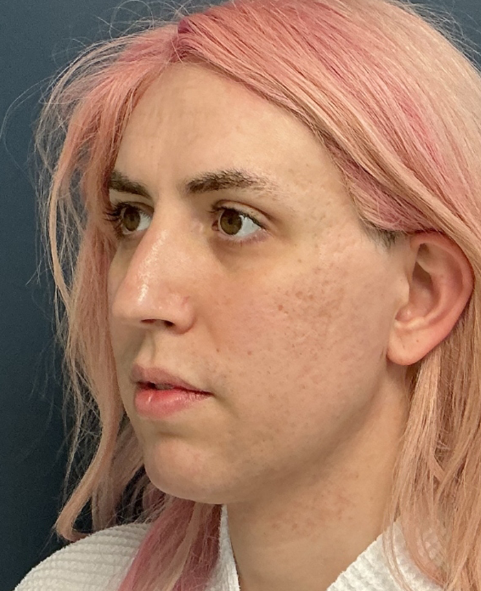 Facial Feminization Surgery case #16093