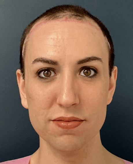 Facial Feminization Surgery case #16093