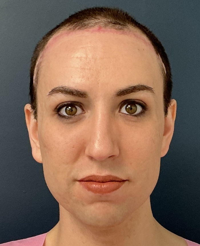 Facial Feminization Surgery case #16093