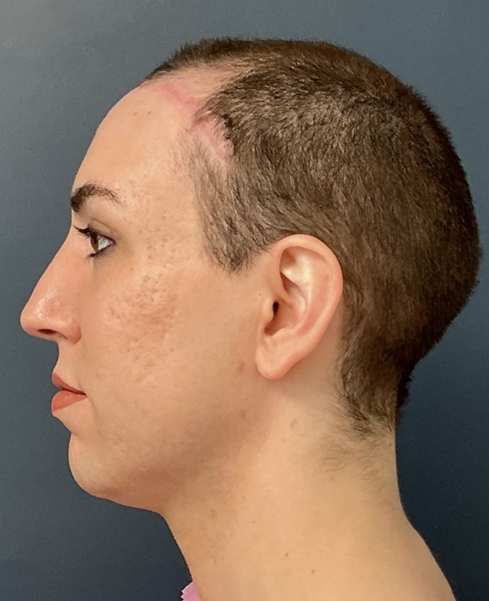 Facial Feminization Surgery case #16093