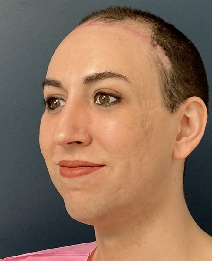 Facial Feminization Surgery case #16093