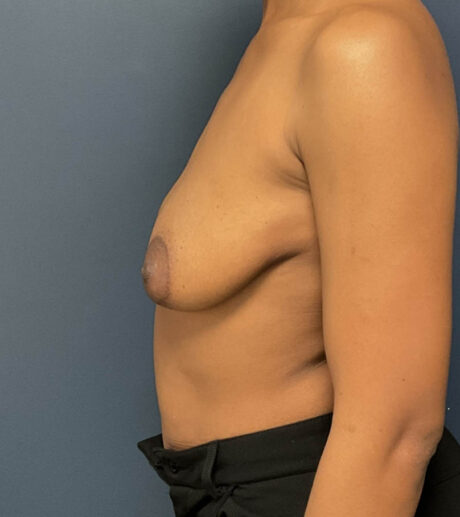 Breast Augmentation case #16501