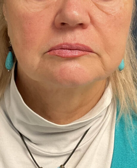 Facelift case #16662