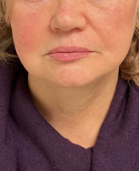 Facelift case #16662