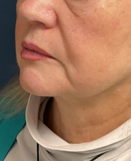 Facelift case #16662