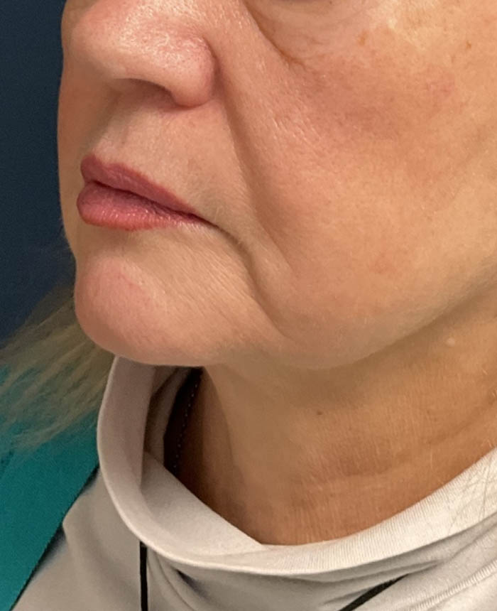 Facelift case #16662