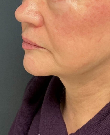 Facelift case #16662