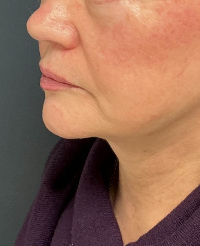 Facelift case #16662