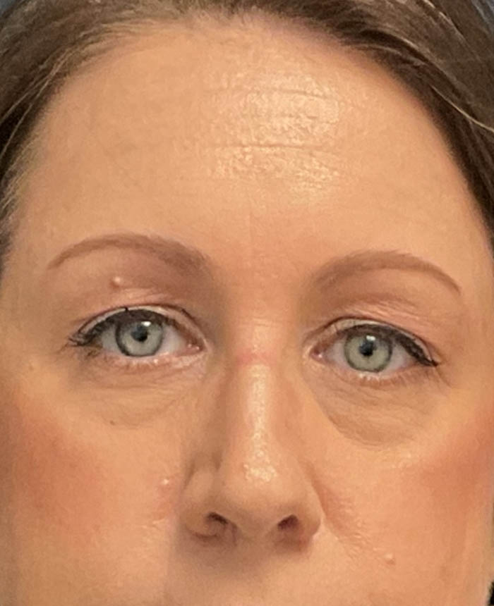 Eyelid Surgery case #16677