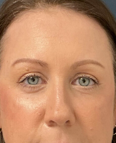 Eyelid Surgery case #16677