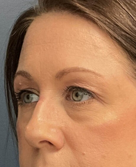 Eyelid Surgery case #16677