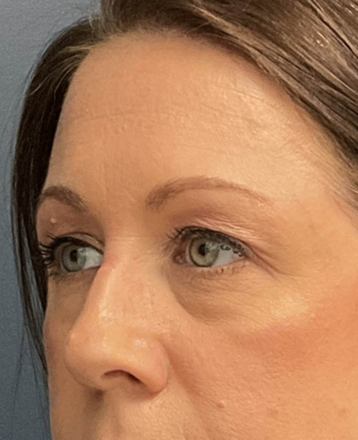 Eyelid Surgery case #16677